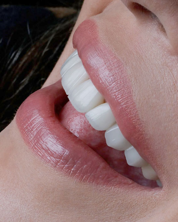 İMPLANT TEDAVİSİYLE DOĞAL GÜLÜŞLER MÜMKÜN